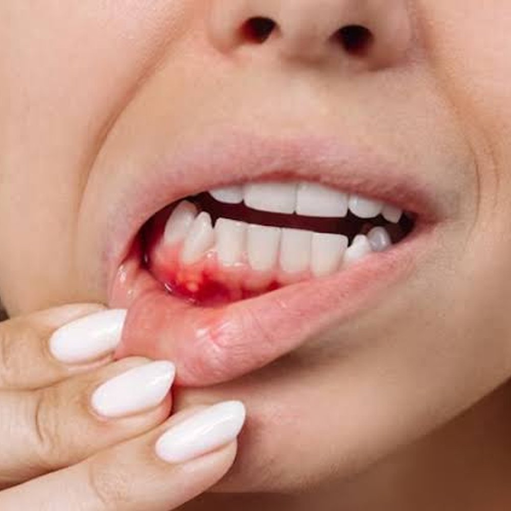 Bleeding and swollen gums close-up