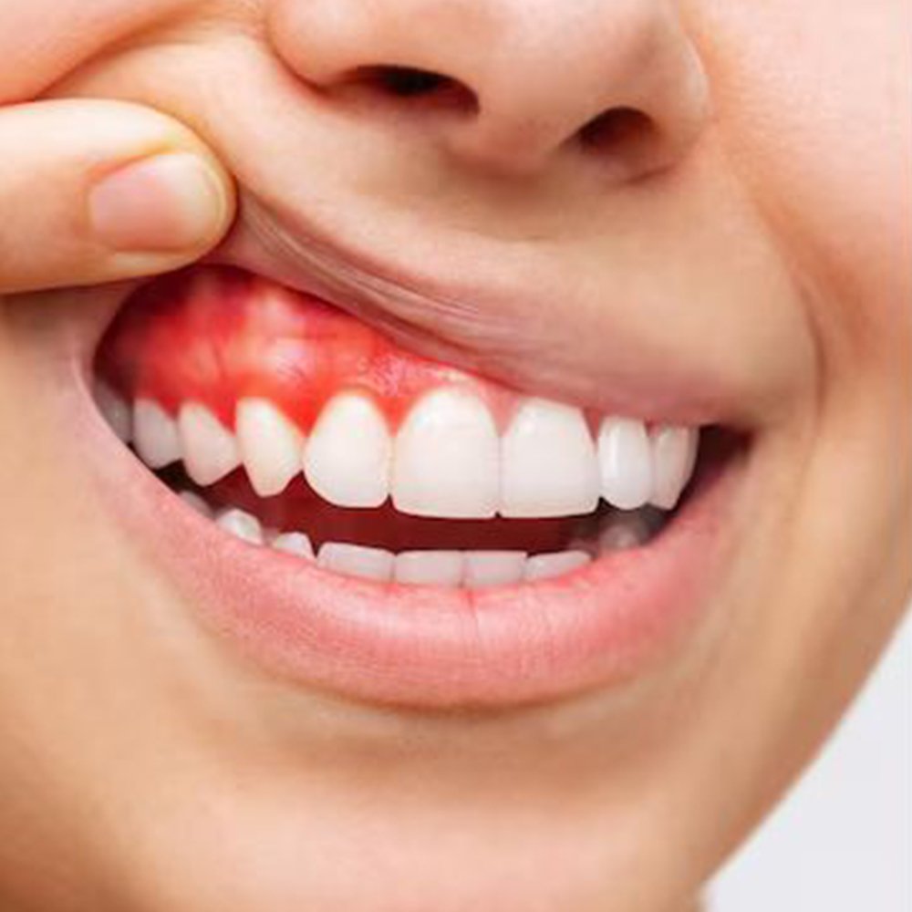 Close-up of inflamed, receding gum line