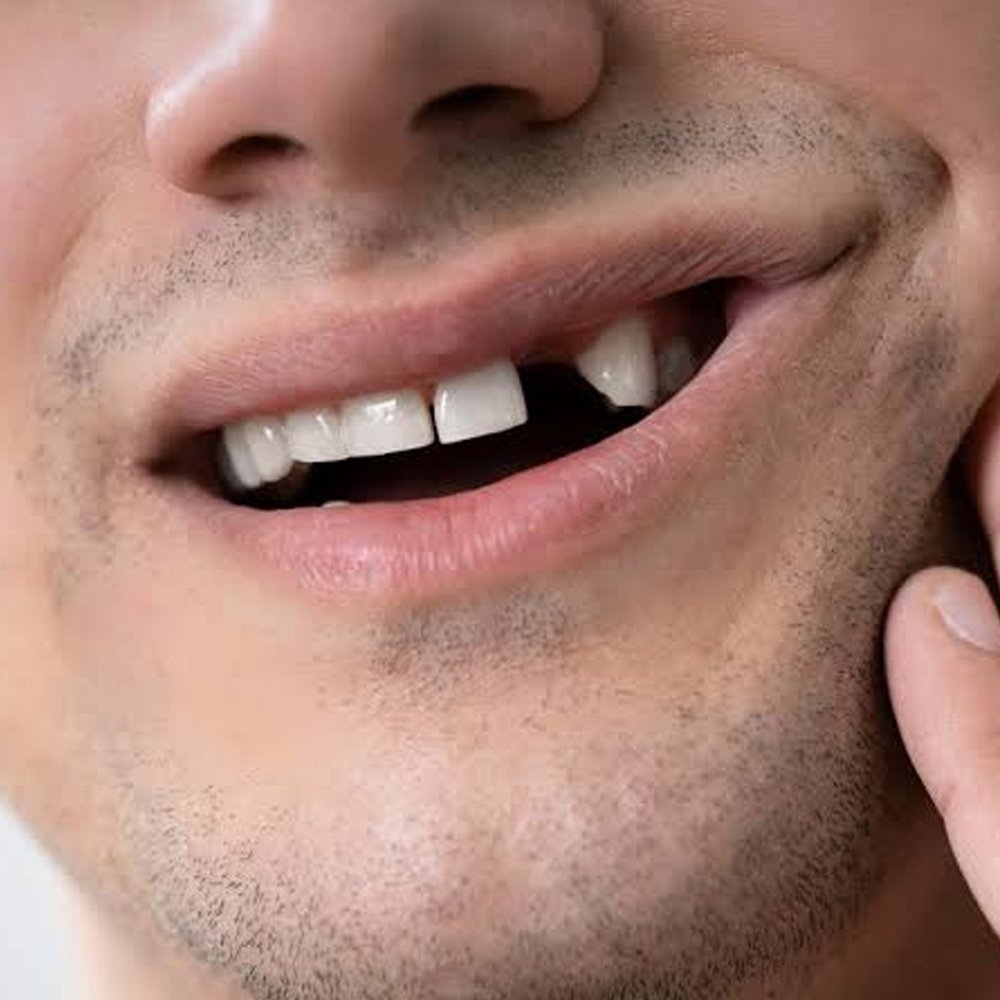 Gap from a lost tooth, a long-term risk of untreated bone loss